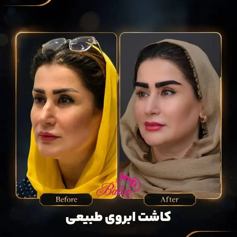 بهترین کلینیک کاشت ابرو مشهد
